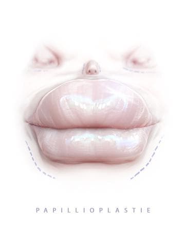 Caterpillarplasty